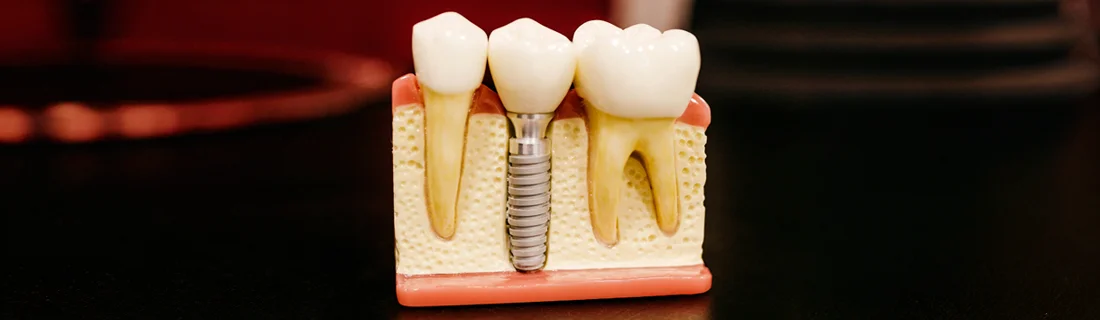 FC – Expert Dental Implants in New York NY at Dental Implant Center NYC